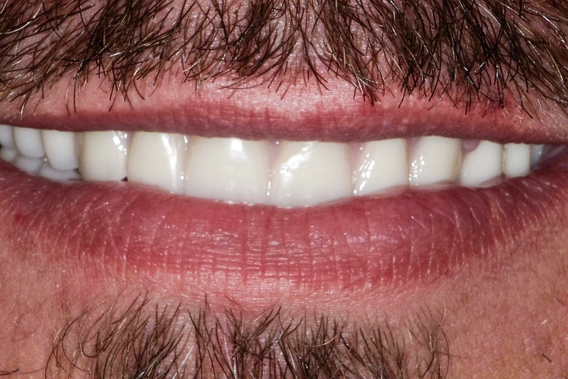 Patient Pritchard After Smile
