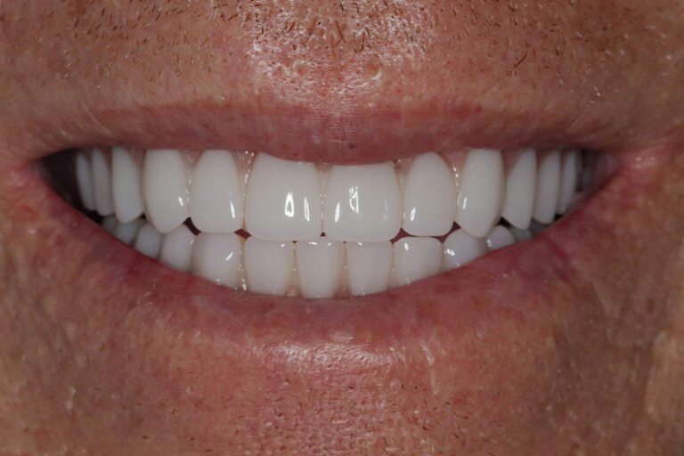 Full Arch Dental Implant White Clean Teeth