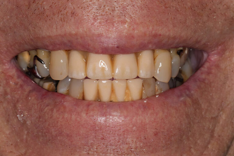 Crooked Yellow Teeth with Bridges