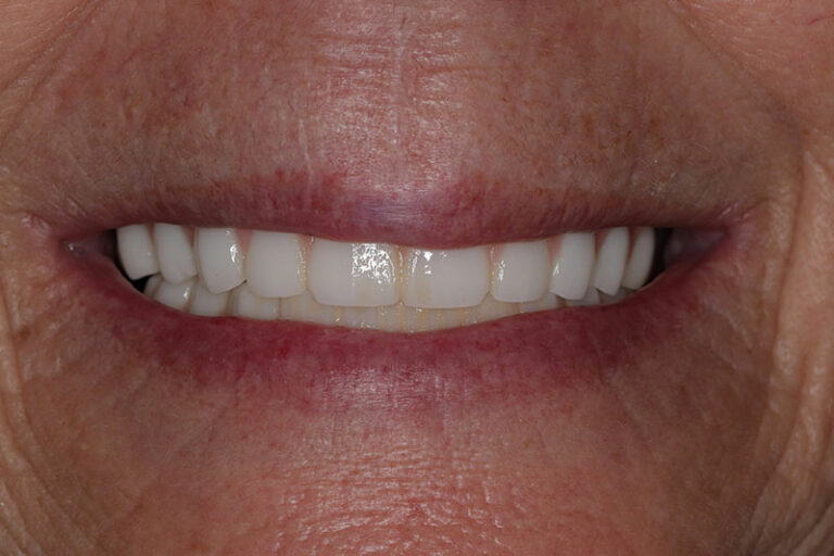 After New Smile with White Straight Teeth