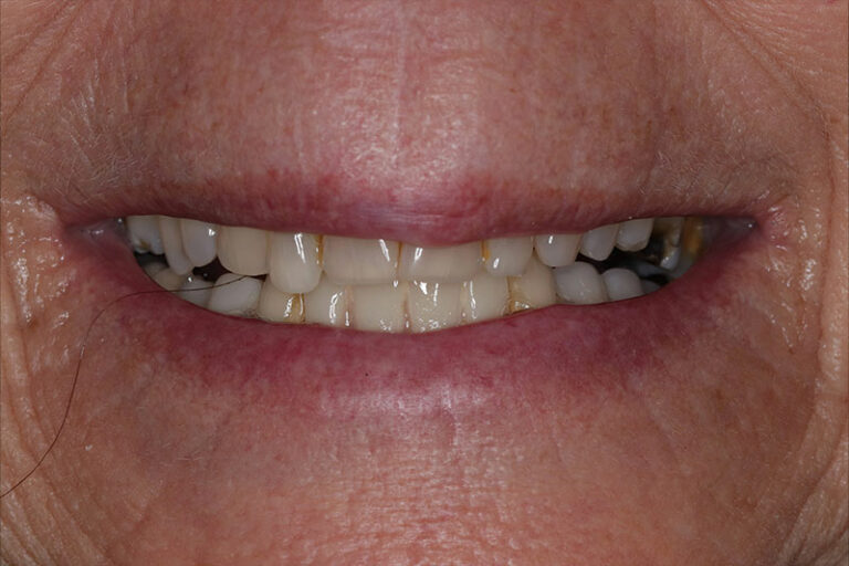 Bruxism, Yellow Teeth