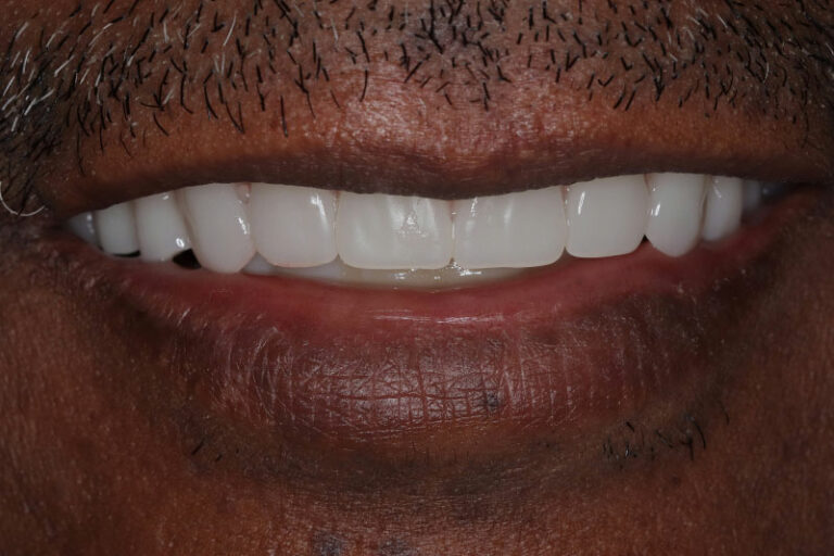 Upper and Lower Arch White Teeth