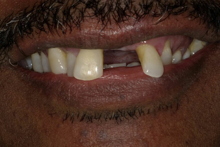 Missing severely crooked teeth