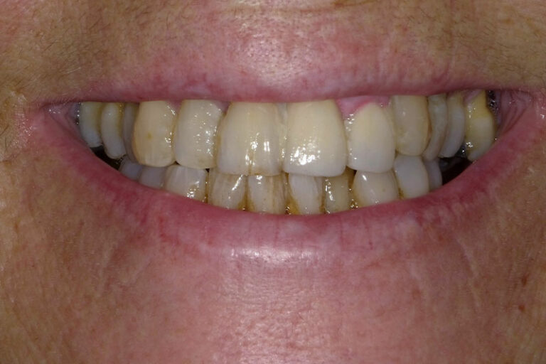 Yellow, Decayed Teeth