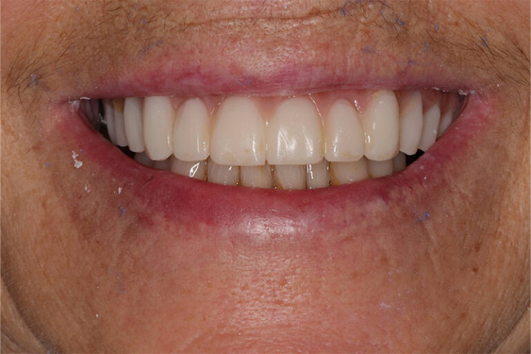 New Smile with White Straight Teeth