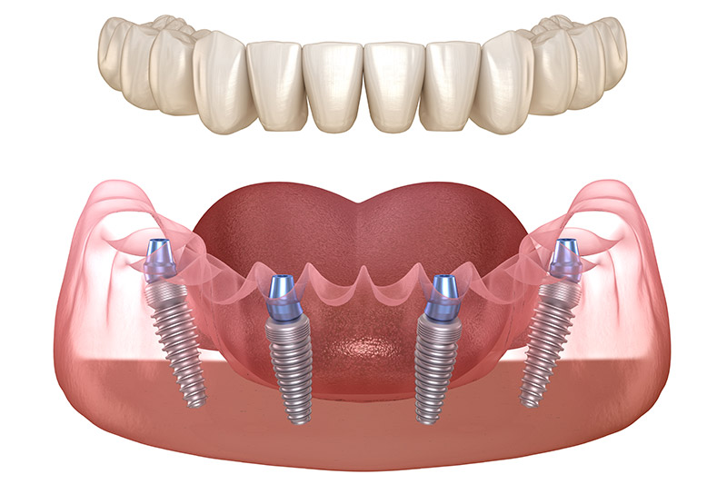 Lower Arch Dental Implants Rendering