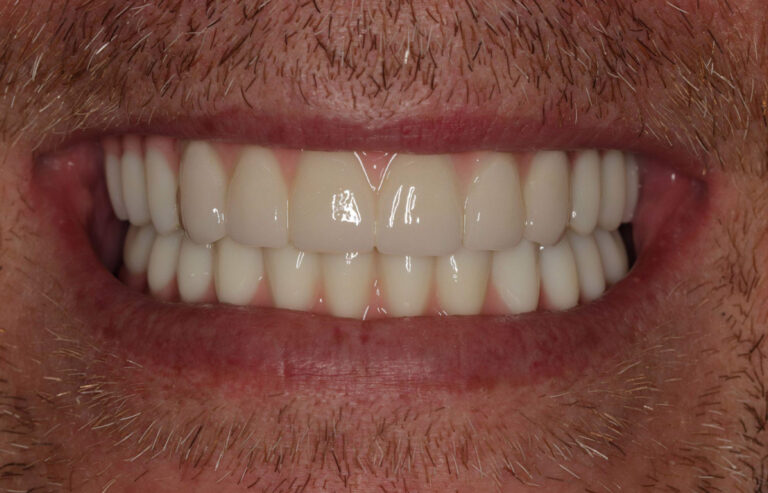 Straight White Smile