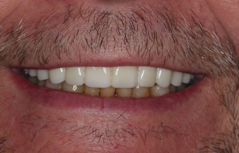 White Straight Upper Implant Teeth