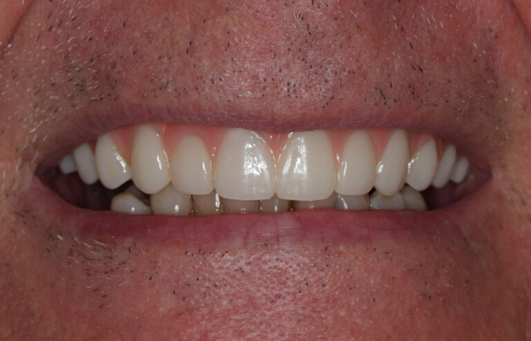Dental Implant White Clean Teeth