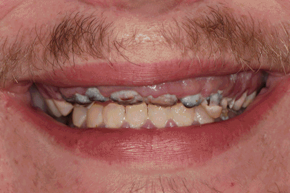 Patient Smiles Before & After Animation 1