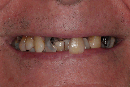 Patient Smiles Before & After Animation 2