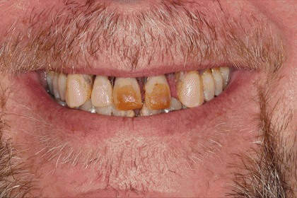 Patient Smiles Before & After Animation 3
