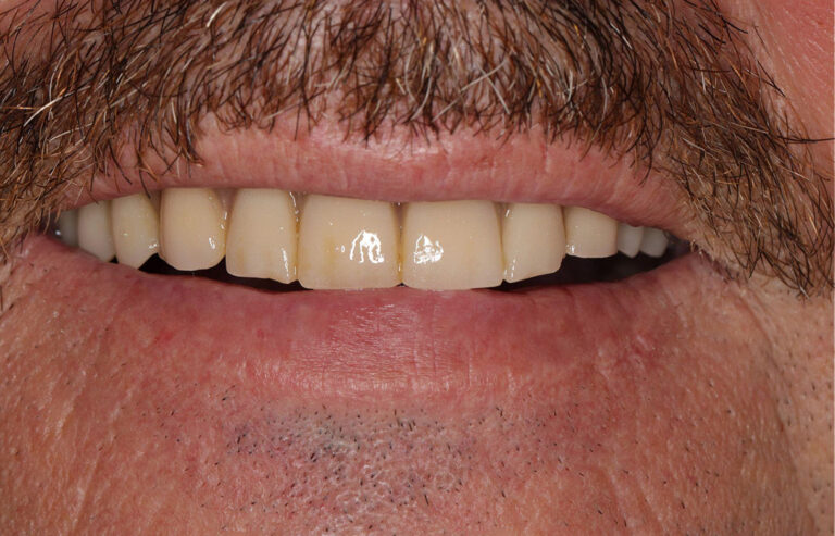 Yellowed Teeth Before