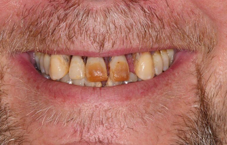 Crooked Gapped Brown Stained Teeth