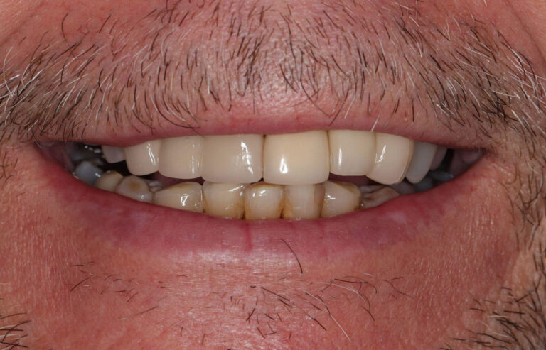 Crooked Yellowed Teeth