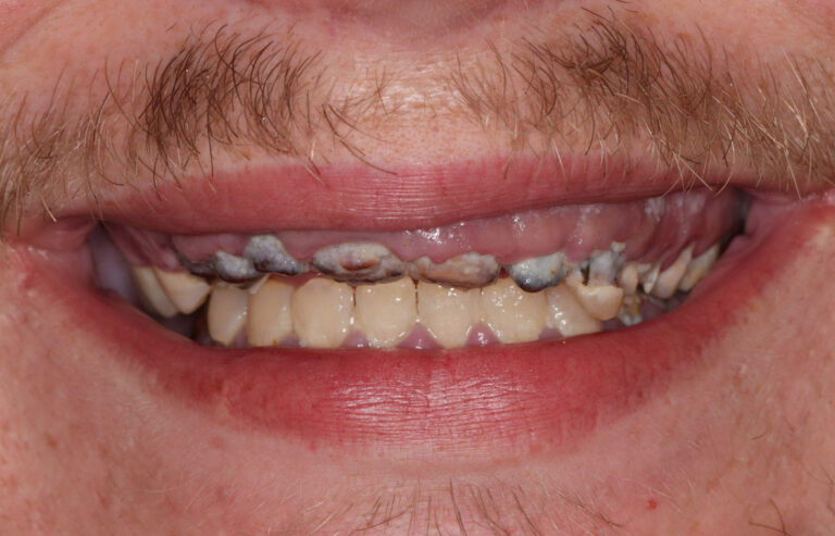Missing Top teeth and Yellowed Bottom Teeth