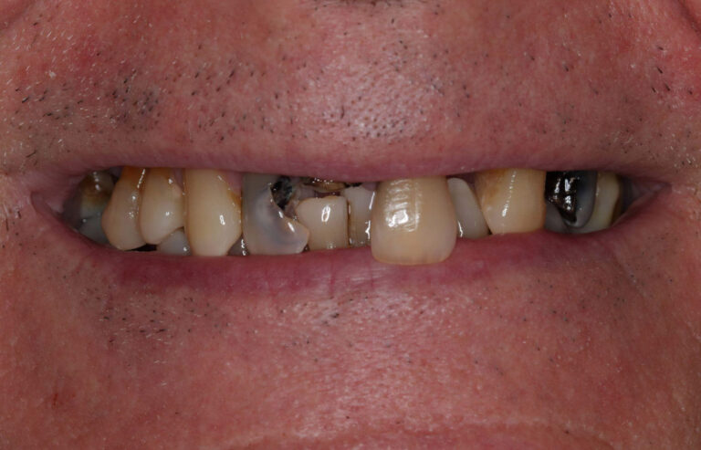 Broken, Crooked, Rotting Teeth