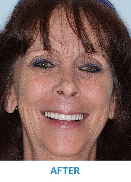 After Smile of Female Patient