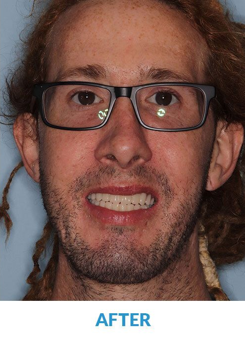 After Smile of Another Male Patient